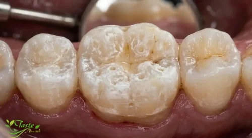 Close-up of tooth enamel affected by acidic beverage exposure